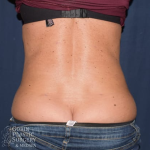 Liposuction Before & After Patient #1230