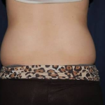 Liposuction Before & After Patient #1234