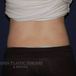 Liposuction Before & After Patient #1234