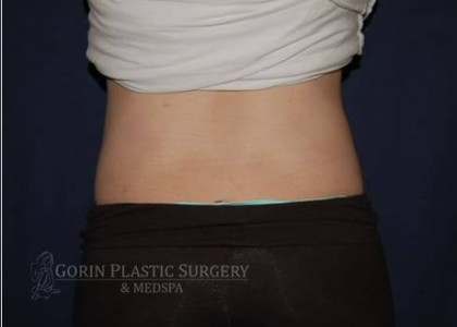 Liposuction Before & After Patient #1234