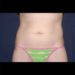 Liposuction Before & After Patient #1236