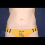 Liposuction Before & After Patient #1236