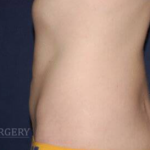 Liposuction Before & After Patient #1236