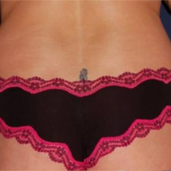 Liposuction Before & After Patient #1240