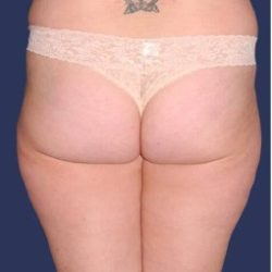Liposuction Before & After Patient #1242