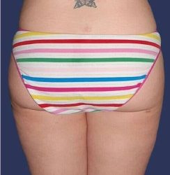 Liposuction Before & After Patient #1242