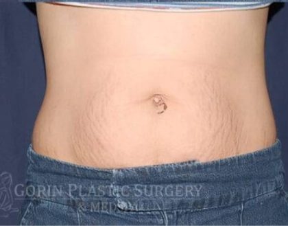 Liposuction Before & After Patient #1242