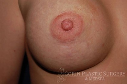 Breast Lift With Implants Before & After Patient #1249