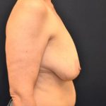 Breast Lift With Implants Before & After Patient #1254