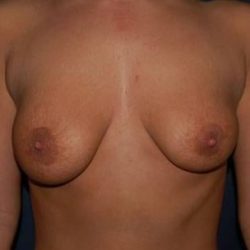 Breast Lift With Implants Before & After Patient #1260