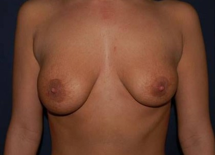 Breast Lift With Implants Before & After Patient #1260