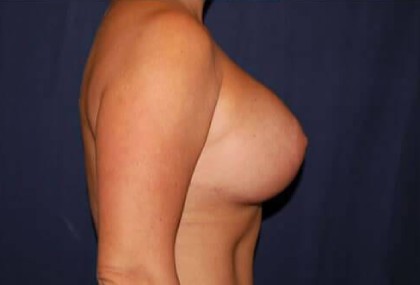 Breast Lift With Implants Before & After Patient #1264