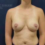 Breast Lift With Implants Before & After Patient #1268