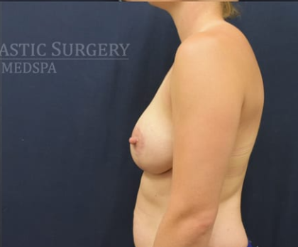 Breast Lift With Implants Before & After Patient #1268