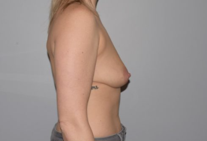 Breast Lift With Implants Before & After Patient #1271