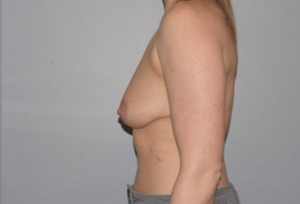 Breast Lift With Implants Before & After Patient #1271