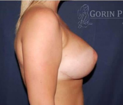 Breast Lift With Implants Before & After Patient #1274