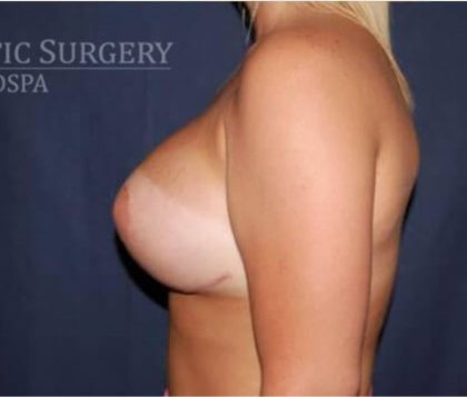 Breast Lift With Implants Before & After Patient #1274
