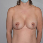 Breast Lift With Implants Before & After Patient #1277