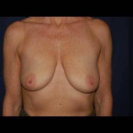 Breast Lift With Implants Before & After Patient #1280