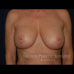 Breast Lift With Implants Before & After Patient #1280