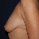 Breast Lift With Implants Before & After Patient #1280