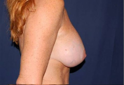 Breast Lift With Implants Before & After Patient #1288