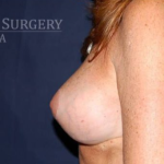 Breast Lift With Implants Before & After Patient #1288