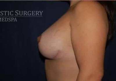 Breast Lift With Implants Before & After Patient #1296