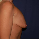 Breast Lift With Implants Before & After Patient #1300