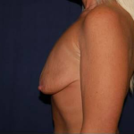 Breast Lift With Implants Before & After Patient #1300