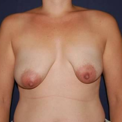 Breast Lift With Implants Before & After Patient #1304