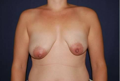 Breast Lift With Implants Before & After Patient #1304
