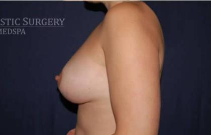 Breast Lift With Implants Before & After Patient #1304