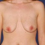 Breast Lift With Implants Before & After Patient #1308