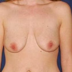 Breast Lift With Implants Before & After Patient #1308