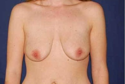 Breast Lift With Implants Before & After Patient #1308