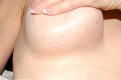 Breast Lift With Implants Before & After Patient #1312