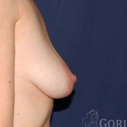 Breast Lift With Implants Before & After Patient #1312