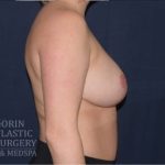 Breast Lift With Implants Before & After Patient #1316