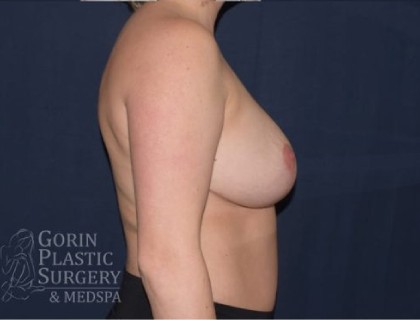 Breast Lift With Implants Before & After Patient #1316