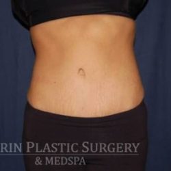 Abdominoplasty - With Liposuction of The Waist Before & After Patient #1319