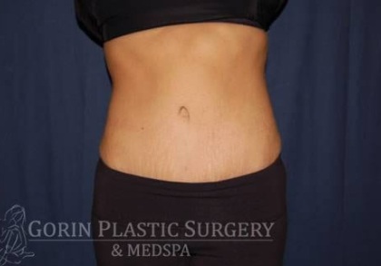 Abdominoplasty - With Liposuction of The Waist Before & After Patient #1319