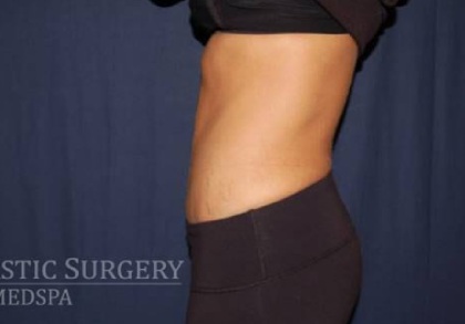 Abdominoplasty - With Liposuction of The Waist Before & After Patient #1319