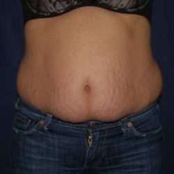 Abdominoplasty - With Liposuction of The Waist Before & After Patient #1319