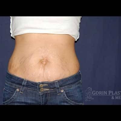 Liposuction Before & After Patient #1326