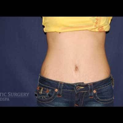 Liposuction Before & After Patient #1326