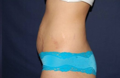 Liposuction Before & After Patient #1326