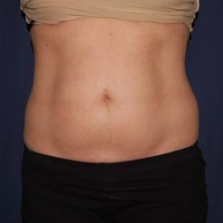Abdominoplasty - With Liposuction of The Waist Before & After Patient #1330