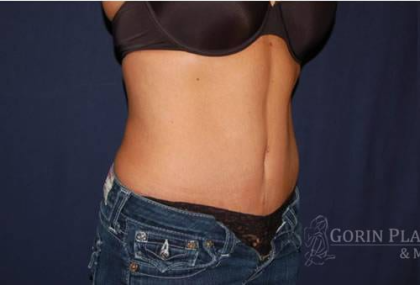 Abdominoplasty - With Liposuction of The Waist Before & After Patient #1330